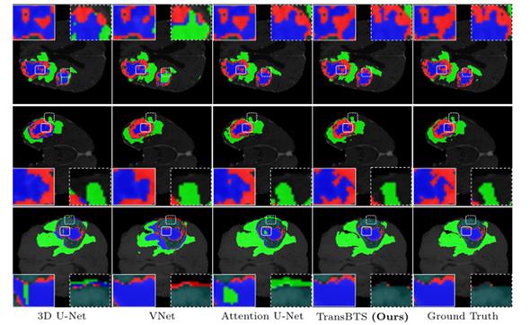 [深度学习论文解读] TransBTS: Multimodal Brain Tumor Segmentation Using Transformer 基于Transformer的多模态脑肿瘤分割 - 文章图片